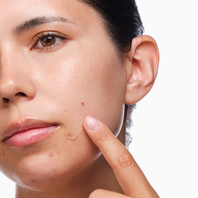 TH ORDINARY ACNE 4